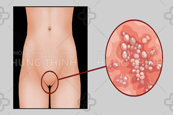  Hình ảnh minh họa bệnh mụn rộp sinh dục