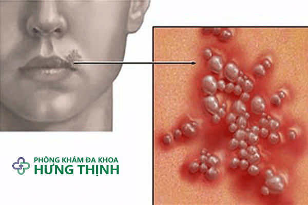 Bệnh mụn rộp sinh dục ở nữ giới
