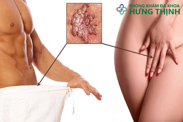 Triệu chứng của bệnh sùi mào qua từng giai đoạn phát triển