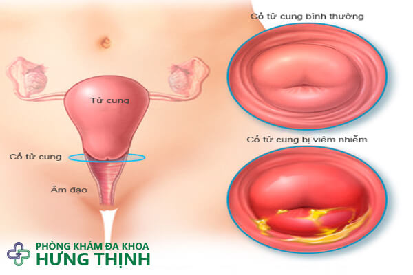 Viêm âm hộ và những điều cần biết