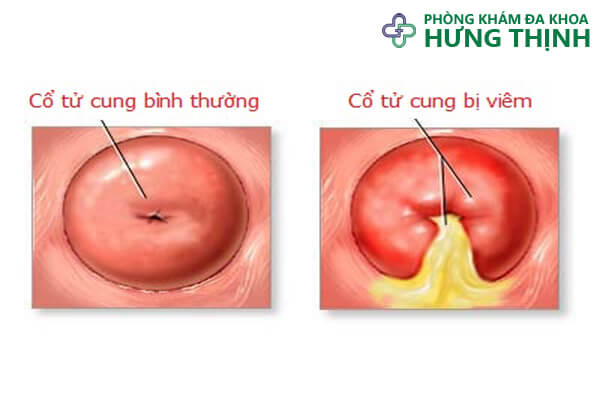 Viêm âm hộ và những điều cần biết