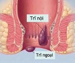 Bệnh trĩ