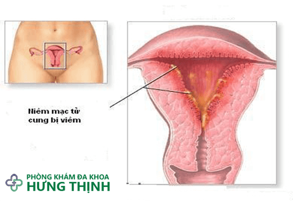 Viêm nội mạc tử cung là gì