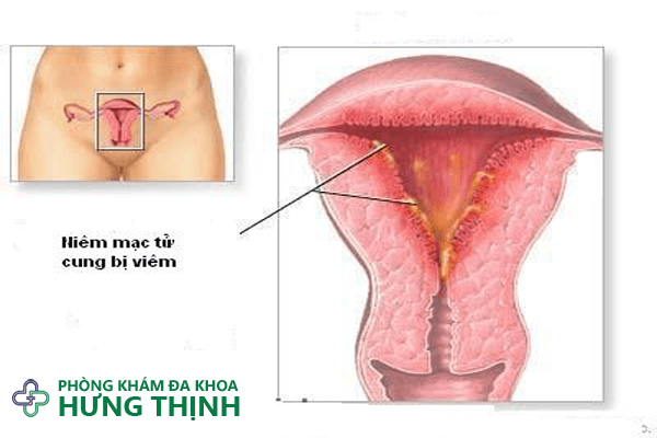Viêm nội mạc tử cung là gì