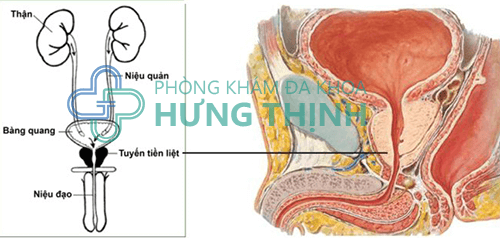Bệnh viêm tuyến tiền liệt ở nam giới