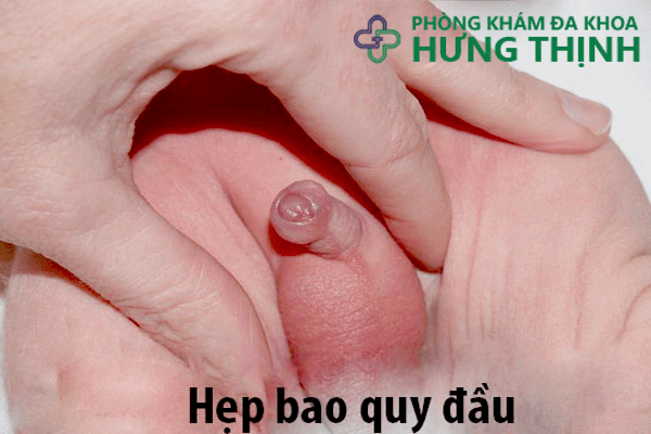 Hẹp bao quy đầu ở trẻ em như thế nào
