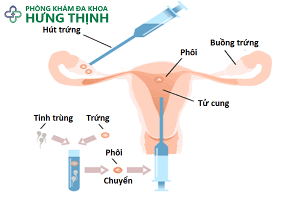 Quy trình thụ tinh trong ống nghiệm