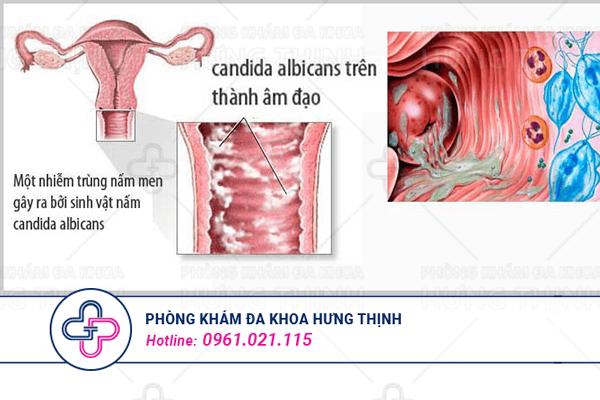 Viêm âm đạo là gì?