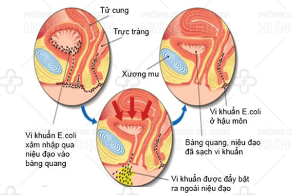 Nguyên nhân gây ra viêm niệu đạo mãn tính
